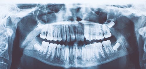 X ray of teeth taken during a dental exam in Melrose