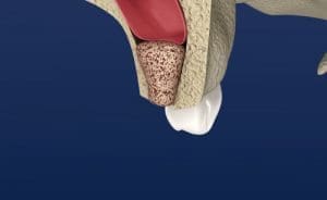 Bone Grafting in Melrose MA