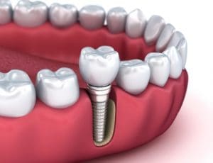 dental implants Melrose MA
