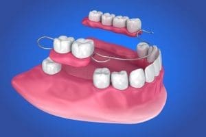 Complete and Partial Dentures in Melrose MA