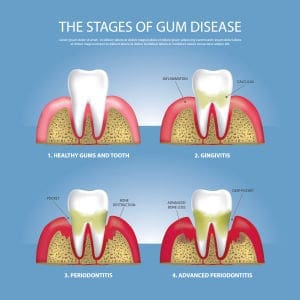 Kelsey Periodontal Group  Deep Cleaning of Teeth - Kelsey Periodontal Group