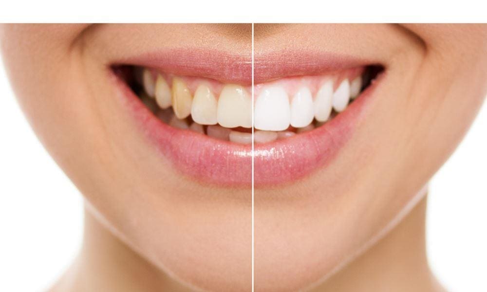 Melrose Dentists | Teeth whitening results.