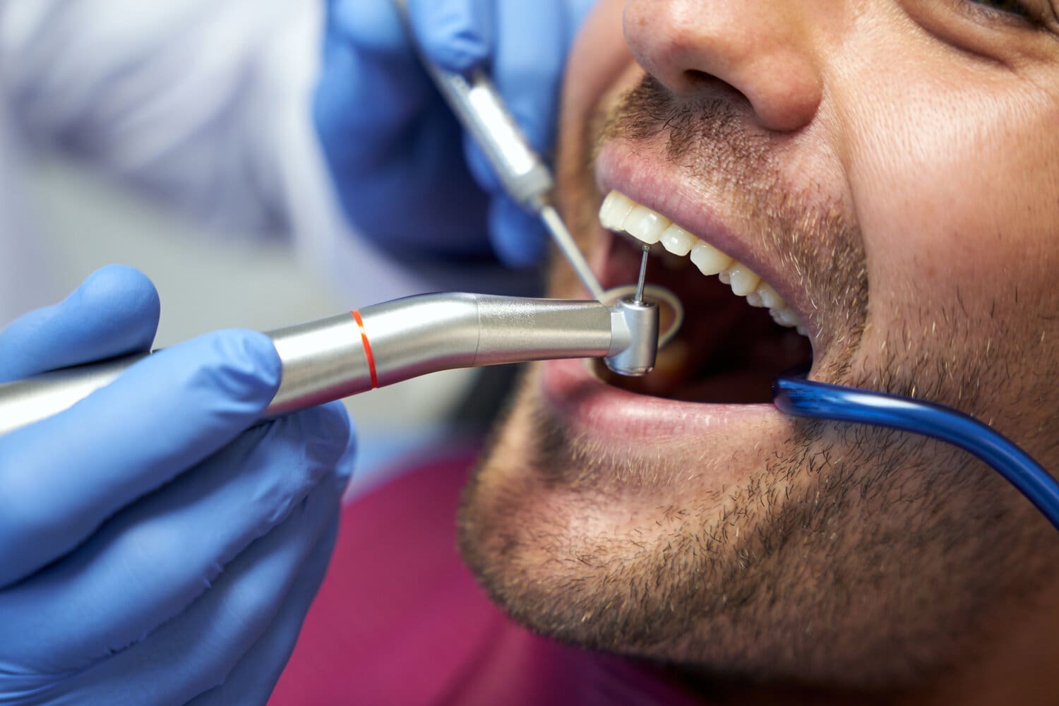 How Dental Sealants Can Help You Prevent Tooth Decay