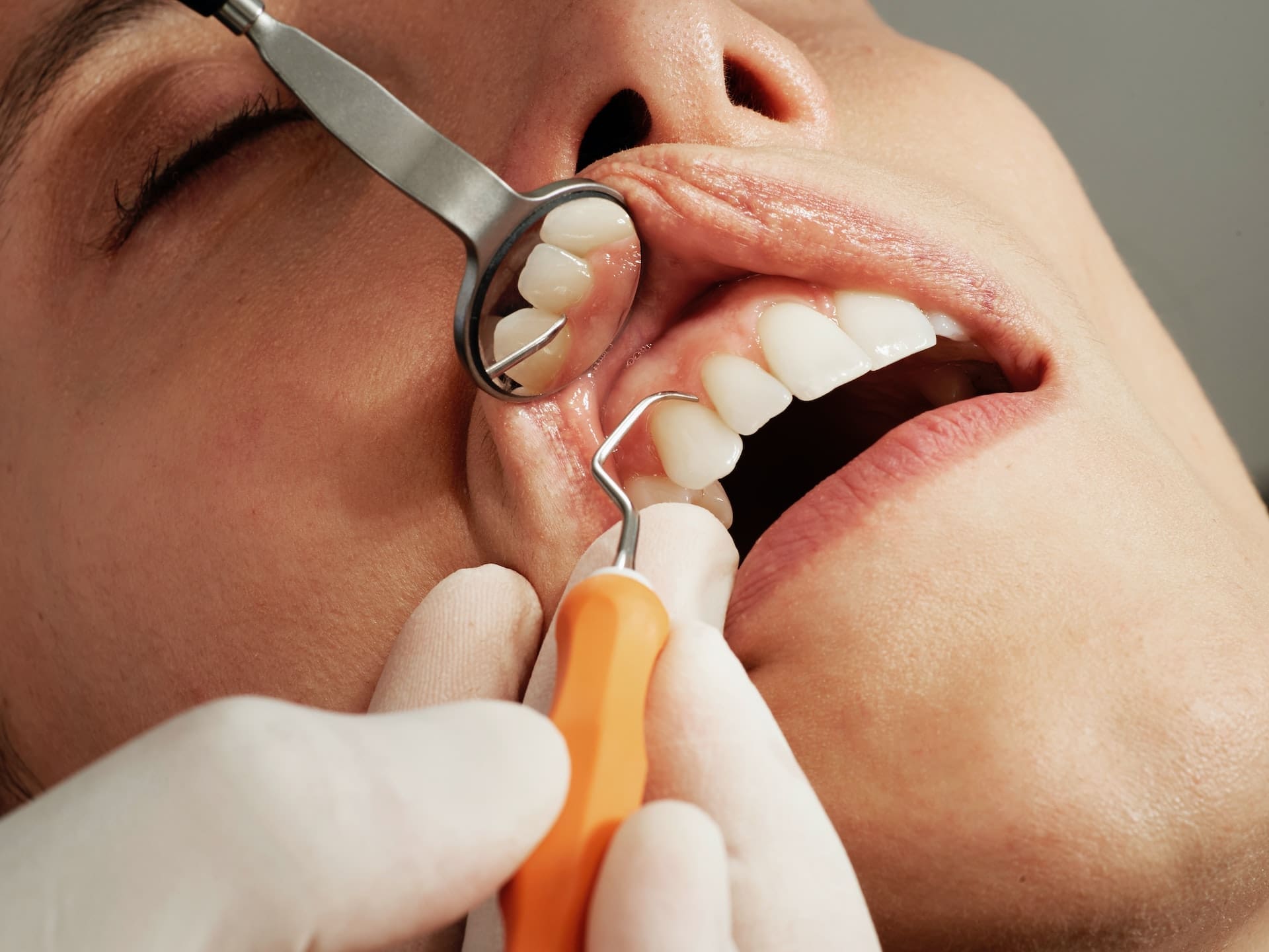 Dental patient having their mouth examined before getting a dental bridge