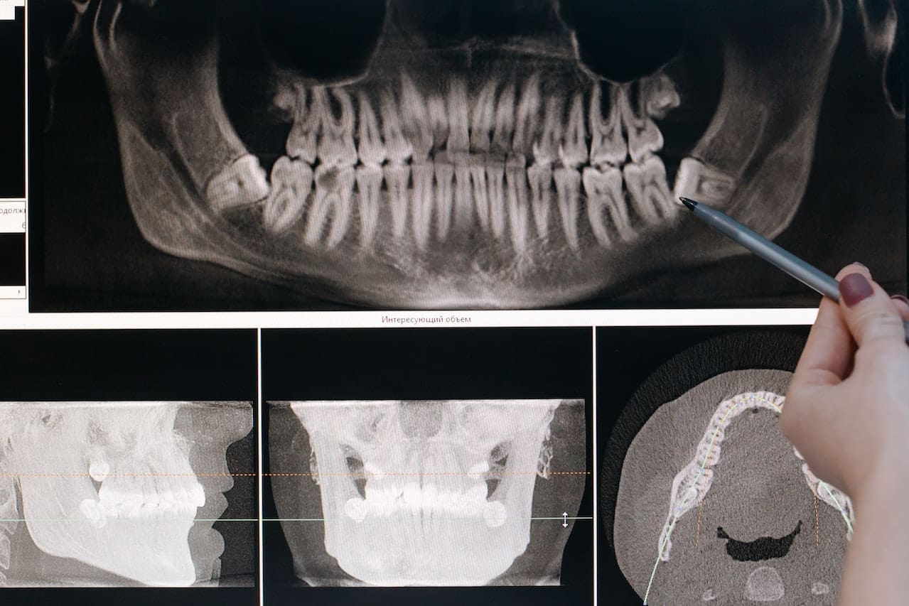 Zirconia Crown