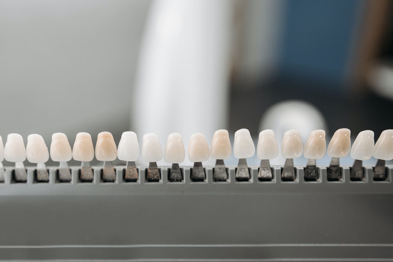 Close-up of dental veneers being applied to a patient's front teeth, showing the transformation to a perfect smile.