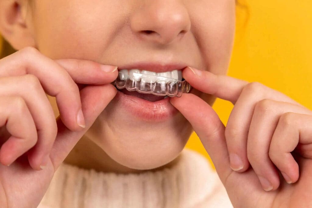 Close up of a woman placing an Invisalign clear aligner over her teeth