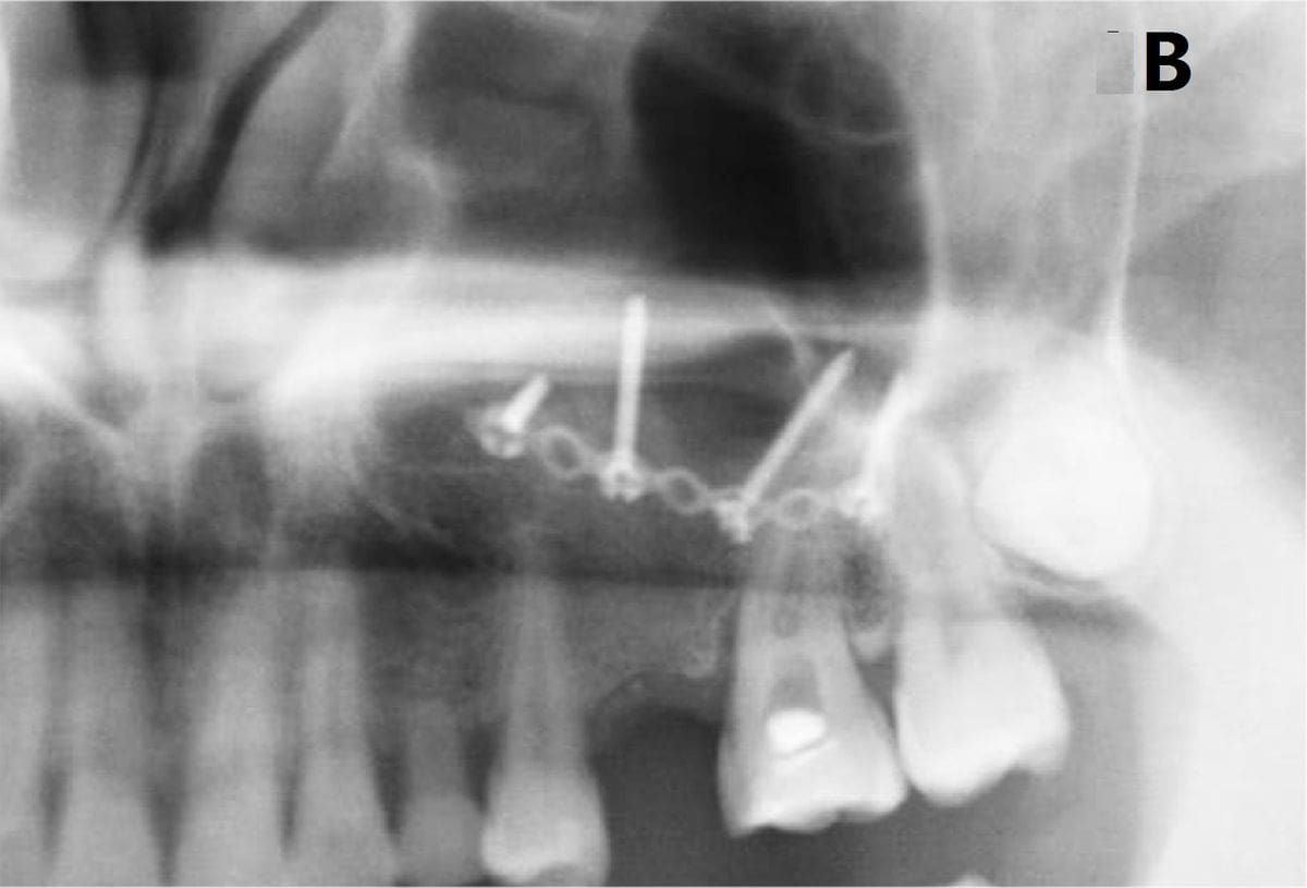 Sinus Lifts augmentations process taking place at Melrose Dental Group