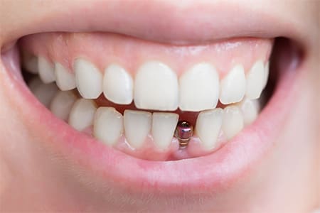 A closeup of a patient’s dental implant abutment