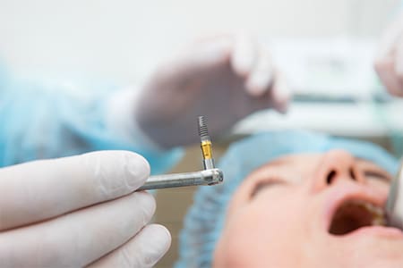 A dentist holding a dental implant as they perform dental implant surgery