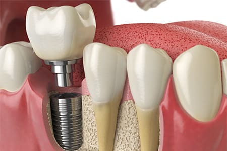 A photo highlighting a man’s completed dental implant