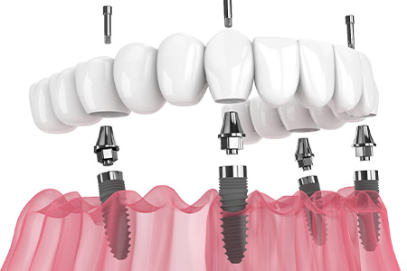 Digital image of All-On-4 dentures.