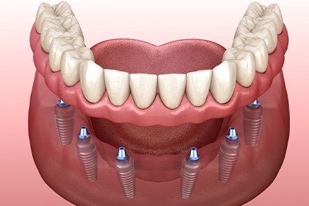 Illustration of denture being attached to dental implant.