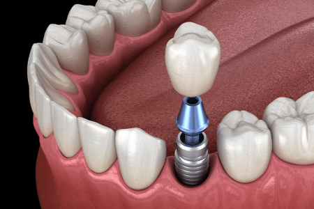 Single dental implant.