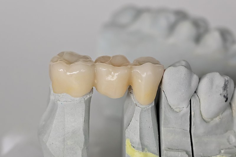 Dental bridge on a mouth mold.