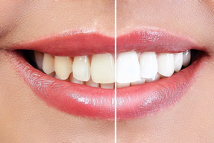 Before and after whitening image