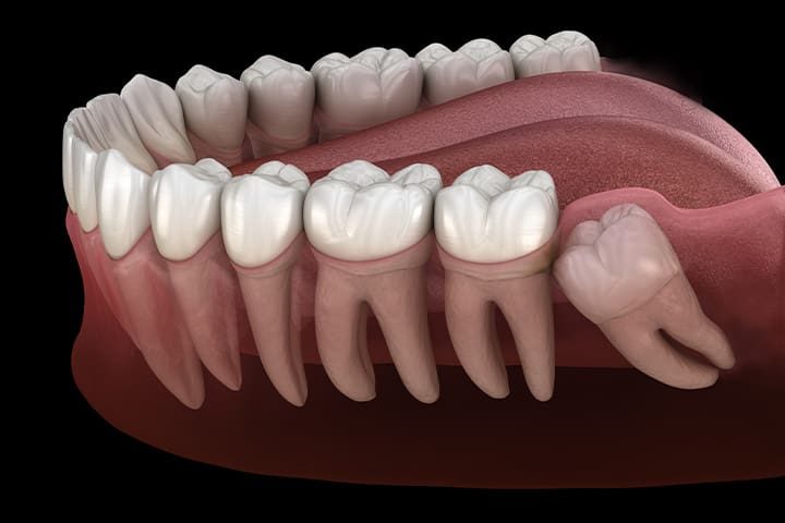 digital-illustration-of-wisdom-teeth-v1.jpg Digital illustration of wisdom teeth