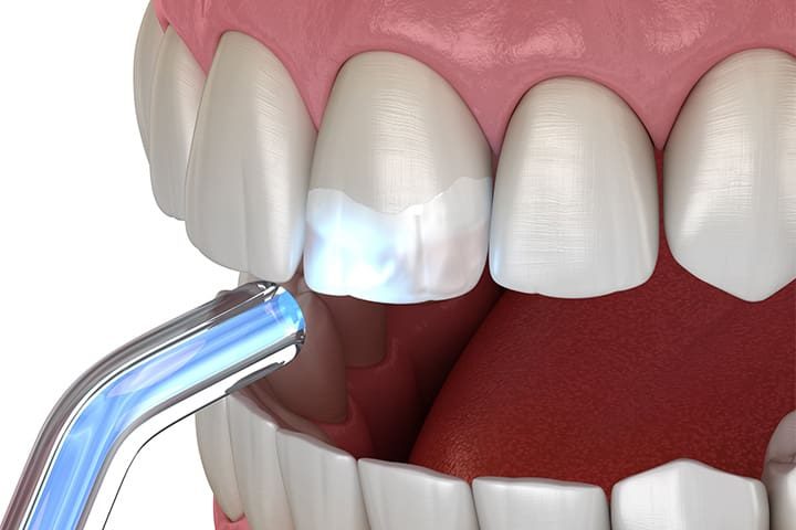Digital image of composite dental bonding