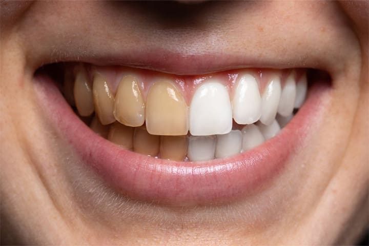 Side-by-side image of stained and whiter teeth