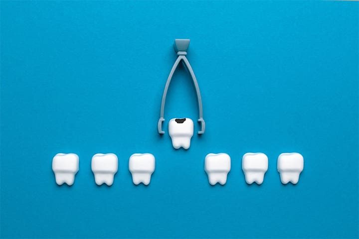 tooth-extraction-graphic-v1 Tooth extraction graphic