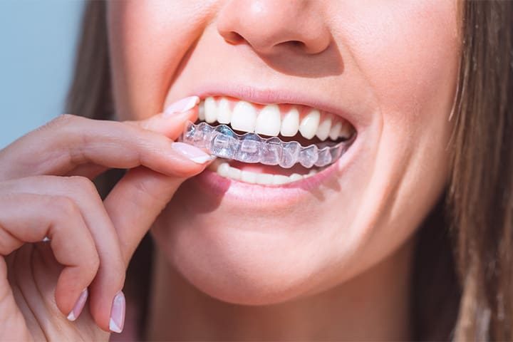 Woman inserting an Invisalign aligner